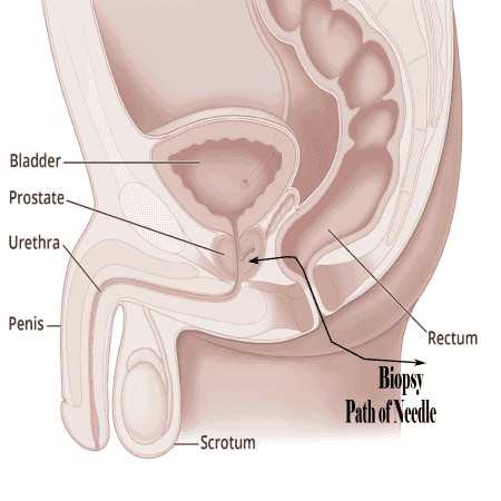 Biopsy Path of Needle
